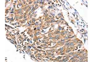 The image on the left is immunohistochemistry of paraffin-embedded Human lung cancer tissue using ABIN7192291(SDC3 Antibody) at dilution 1/30, on the right is treated with synthetic peptide. (SDC3 anticorps)