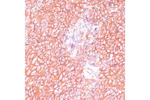 Immunohistochemistry of paraffin-embedded human oophoroma using MOB4 antibody (ABIN6132926, ABIN6143935, ABIN6143936 and ABIN6220703) at dilution of 1:100 (40x lens). (MOBKL3 anticorps  (AA 1-225))