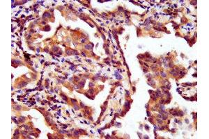 IHC image of ABIN7157898 diluted at 1:200 and staining in paraffin-embedded human lung cancer performed on a Leica BondTM system.