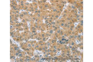 Immunohistochemistry of Human liver cancer using CYP2C9 Polyclonal Antibody at dilution of 1:35 (CYP2C9 anticorps)