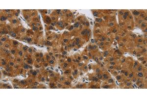 Immunohistochemistry of paraffin-embedded Human liver cancer tissue using GATA5 Polyclonal Antibody at dilution 1:50 (GATA5 anticorps)