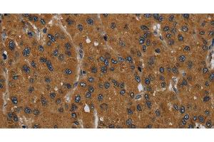 Immunohistochemistry of paraffin-embedded Human liver cancer tissue using MIER2 Polyclonal Antibody at dilution 1:60 (MIER2 anticorps)