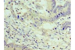 Immunohistochemistry of paraffin-embedded human colon cancer using ABIN7176056 at dilution of 1:100 (ZEB2 anticorps  (AA 1050-1214))