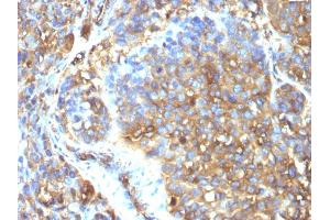 Formalin-fixed, paraffin-embedded human Melanoma stained with Moesin Mouse Monoclonal Antibody (MSN/493). (Moesin anticorps)