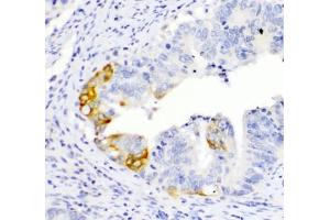 IHC testing of FFPE human intestinal cancer with TL1A antibody. (TNFSF15 anticorps)