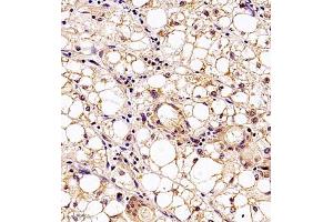 Immunohistochemistry analysis of paraffin embedded human liver cancer using MTHFD1 (ABIN7074609) at dilution of 1: 700