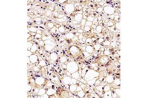 Immunohistochemistry analysis of paraffin embedded human liver cancer using MTHFD1 (ABIN7074609) at dilution of 1: 700 (MTHFD1 anticorps)