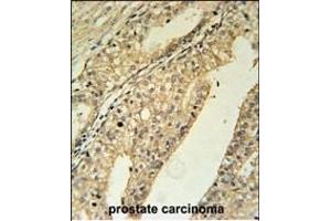TME Antibody (N-term) (ABIN651651 and ABIN2840344) immunohistochemistry analysis in formalin fixed and paraffin embedded human prostate carcinoma followed by peroxidase conjugation of the secondary antibody and DAB staining. (TMEM134 anticorps  (N-Term))