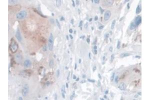IHC-P analysis of Human Breast cancer Tissue, with DAB staining. (Kallikrein 14 anticorps  (AA 36-267))