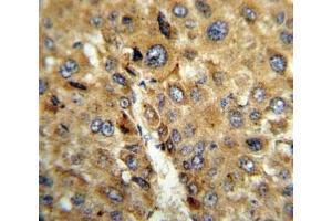 IHC analysis of FFPE human hepatocarcinoma stained with TAT antibody (Tat (AA 279-306) anticorps)