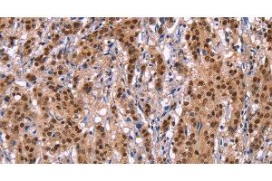 Immunohistochemistry of paraffin-embedded Human gastric cancer tissue using Ephrin A5 Polyclonal Antibody at dilution 1:40 (Ephrin A5 anticorps)
