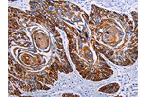 The image on the left is immunohistochemistry of paraffin-embedded Human esophagus cancer tissue using ABIN7190455(DEFA1 Antibody) at dilution 1/15, on the right is treated with synthetic peptide.