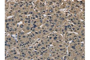 The image on the left is immunohistochemistry of paraffin-embedded Human liver cancer tissue using ABIN7191092(IMPAD1 Antibody) at dilution 1/20, on the right is treated with synthetic peptide. (IMPAD1 anticorps)