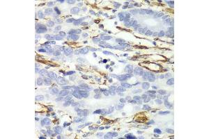 Immunohistochemistry of paraffin-embedded human gastric cancer using CALD1 antibody. (Caldesmon anticorps  (AA 1-240))