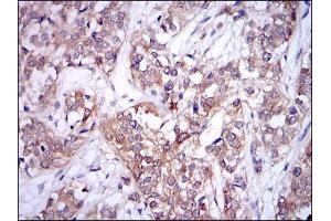 Immunohistochemical analysis of paraffin-embedded bladder cancer tissues using UBE2I mouse mAb with DAB staining.