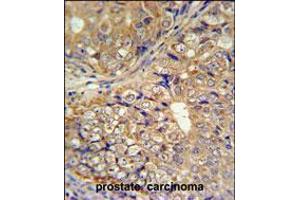 KLHL9 Antibody IHC analysis in formalin fixed and paraffin embedded human prostate carcinoma followed by peroxidase conjugation of the secondary antibody and DAB staining. (KLHL9 anticorps  (AA 299-326))