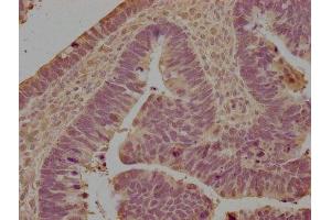 IHC image of ABIN7158278 diluted at 1:100 and staining in paraffin-embedded human ovarian cancer performed on a Leica BondTM system.