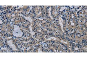 Immunohistochemistry of paraffin-embedded Human thyroid cancer tissue using PIK3CB Polyclonal Antibody at dilution 1:50