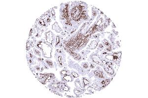 Papillary renal cell carcinoma showing a delicate collagen IV positive membrane between tumor cells and the stroma and an intense staining of vessels