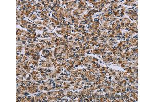Immunohistochemistry of Human prostate cancer using GTPBP10 Polyclonal Antibody at dilution of 1:60 (GTPBP10 anticorps)
