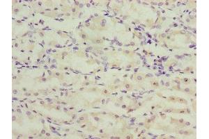 Immunohistochemistry of paraffin-embedded human gastric cancer using ABIN7173269 at dilution of 1:100 (TMEM71 anticorps  (AA 1-210))