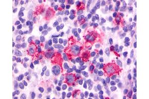 Anti-F2RL3 / PAR4 antibody IHC of human Lymph Node, Hodgkins Lymphoma.