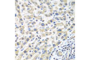 Immunohistochemistry of paraffin-embedded human liver cancer using IL2 antibody at dilution of 1:100 (40x lens). (IL-2 anticorps)