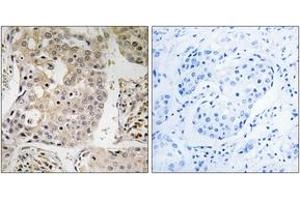Immunohistochemistry analysis of paraffin-embedded human breast carcinoma tissue, using MRPL41 Antibody. (MRPL41 anticorps  (AA 81-130))