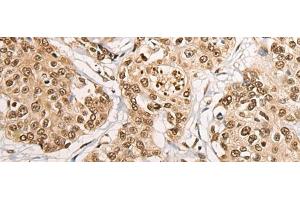 Immunohistochemistry of paraffin-embedded Human prost at e cancer tissue using PHF21A Polyclonal Antibody at dilution of 1:50(x200)