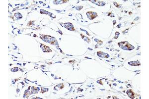 Immunohistochemistry of paraffin-embedded human breast cancer using S100A10 antibody (ABIN6290226) at dilution of 1:100 (40x lens). (S100A10 anticorps)