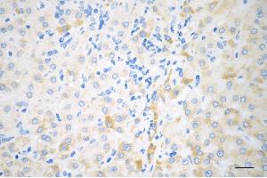 Immunohistochemistry was performed on paraffin-embedded human hepatocarcinoma using BCKDK antibody (ABIN7797783), 1:200).