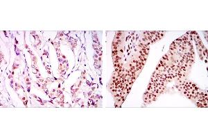 Immunohistochemical analysis of paraffin-embedded breast cancer tissues (left) and ovarian cancer tissues (right) using PSIP1 mouse mAb with DAB staining.