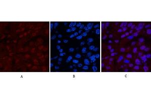 Immunofluorescence analysis of human liver cancer tissue. (XRCC4 anticorps)