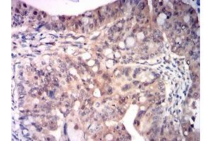 Immunohistochemical analysis of paraffin-embedded rectum cancer tissues using RRM1 mouse mAb with DAB staining. (RRM1 anticorps  (AA 541-792))