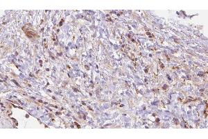 ABIN6272698 at 1/100 staining Human liver cancer tissue by IHC-P. (Leukotriene B4 Receptor/BLT anticorps)