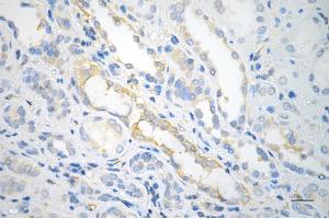 Immunohistochemistry was performed on paraffin-embedded human renal carcinoma using MYH9 antibody (ABIN7799519), 1:). (Myosin 9 anticorps)