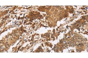 Immunohistochemistry of paraffin-embedded Human gasrtic cancer tissue using CALU Polyclonal Antibody at dilution 1:40