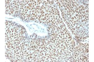 Formalin-fixed, paraffin-embedded human Cervical Tumor stained with Phospho c-Jun Mouse Monoclonal Antibody (C-J 4C4/1).