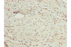 Immunohistochemistry of paraffin-embedded human bladder cancer using ABIN7162864 at dilution of 1:100 (PPIL4 anticorps  (AA 1-492))