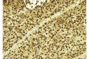 ABIN6275312 at 1/100 staining Human breast cancer tissue by IHC-P. (SP100 anticorps  (Internal Region))