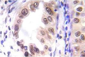 Immunohistochemistry (IHC) analyzes of p-STAT1 antibody in paraffin-embedded human lung carcinoma tissue. (STAT1 anticorps  (pSer727))