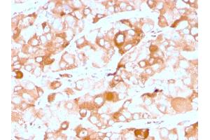 Formalin-fixed, paraffin-embedded human breast carcinoma stained with Prolactin Receptor Recombinant Mouse Monoclonal Antibody (rPRLR742).