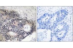 Immunohistochemistry analysis of paraffin-embedded human colon carcinoma, using ABHD12B Antibody. (ABHD12B anticorps  (AA 281-330))