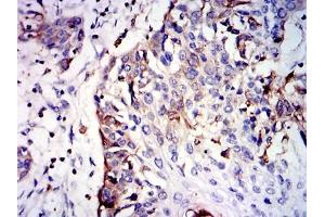 Immunohistochemical analysis of paraffin-embedded esophageal cancer tissues using GSTM1 mouse mAb with DAB staining.