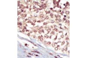Formalin-fixed and paraffin-embedded human cancer tissue reacted with the primary antibody, which was peroxidase-conjugated to the secondary antibody, followed by AEC staining. (EPH Receptor A5 anticorps  (C-Term))
