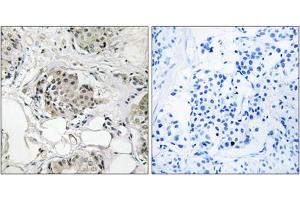 Immunohistochemistry analysis of paraffin-embedded human breast carcinoma tissue, using USP13 antibody. (USP13 anticorps  (C-Term))