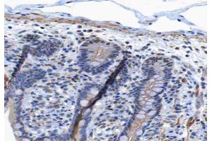ABIN6267265 at 1/200 staining human colon carcinoma tissue sections by IHC-P.
