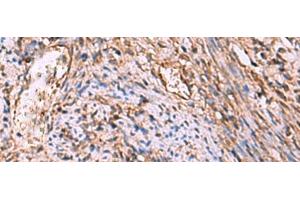 Immunohistochemistry of paraffin-embedded Human cervical cancer tissue using RHAG Polyclonal Antibody at dilution of 1:130(x200)