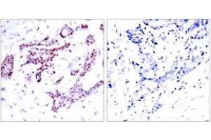 Immunohistochemistry analysis of paraffin-embedded human breast carcinoma, using STAT1 (Phospho-Tyr701) Antibody. (STAT1 anticorps  (pTyr701))