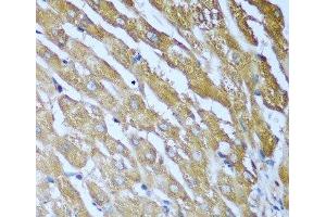 Immunohistochemistry of paraffin-embedded Human liver using IGF2BP3 Polyclonal Antibody at dilution of 1:100 (40x lens). (IGF2BP3 anticorps)
